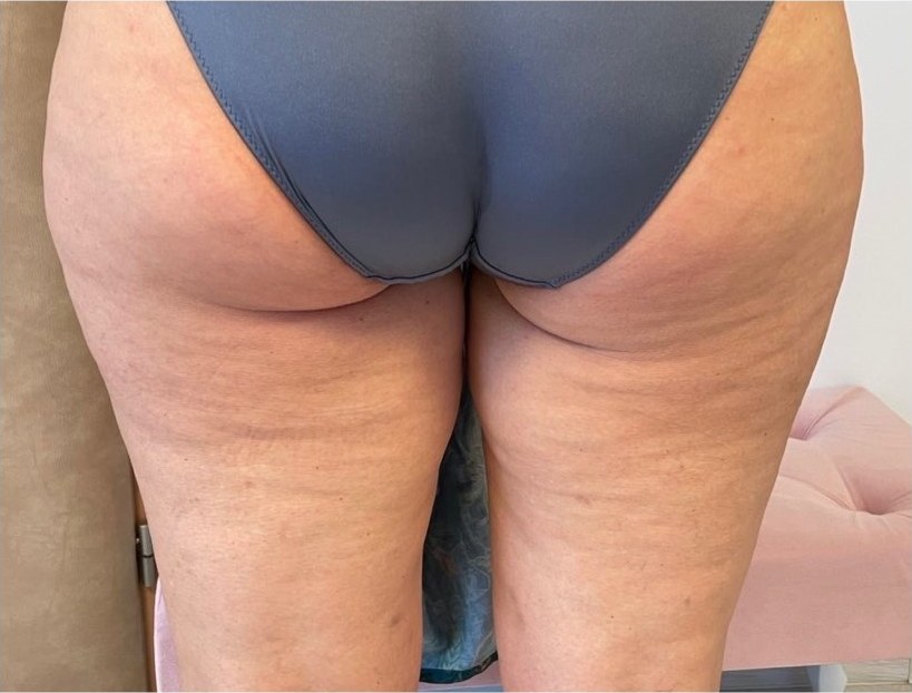 Liečba celulitídy BTL X-WAVE po ošetrení - HB Clinic Košice
