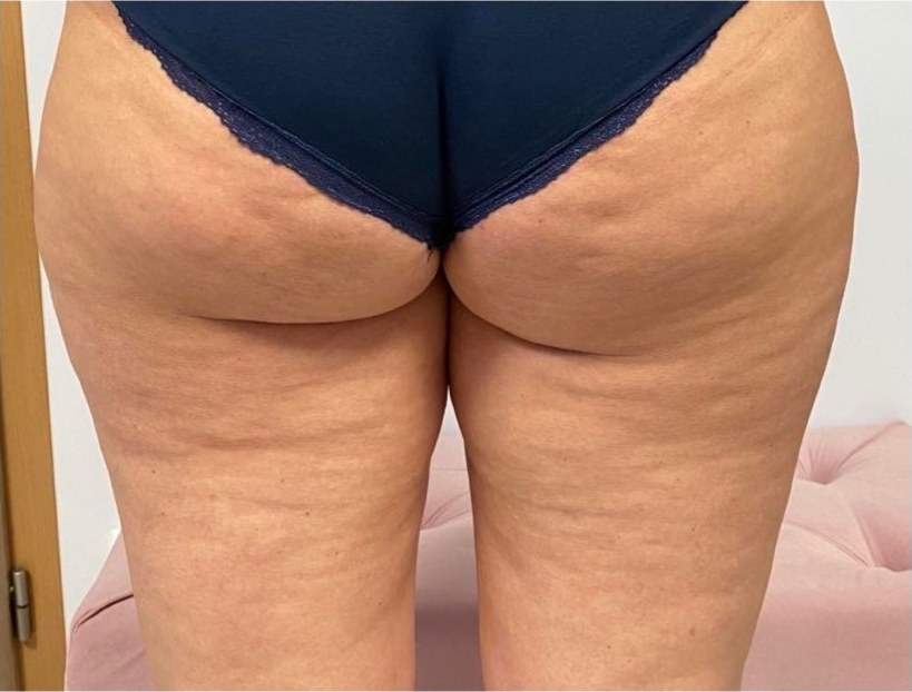 Liečba celulitídy BTL X-WAVE pred ošetrením - HB Clinic Košice