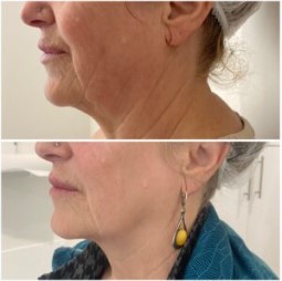 HIFU lifting pred a po - HB Clinic Košice